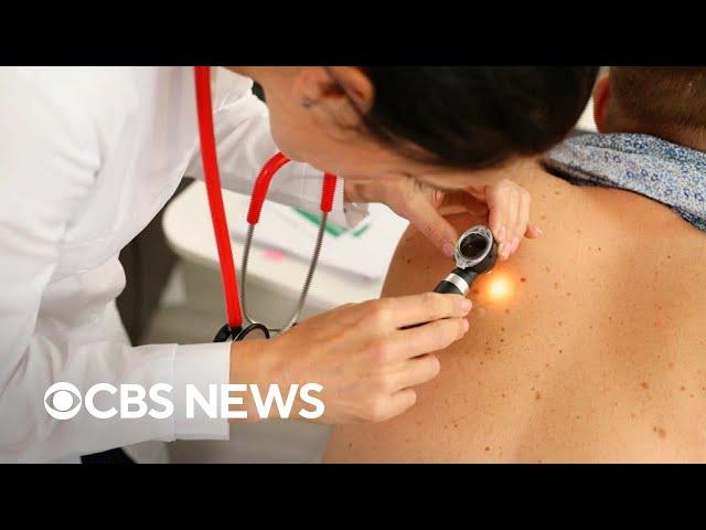 Dermatologists battle online "anti-sunscreen movement" spreading misinformation, health risks