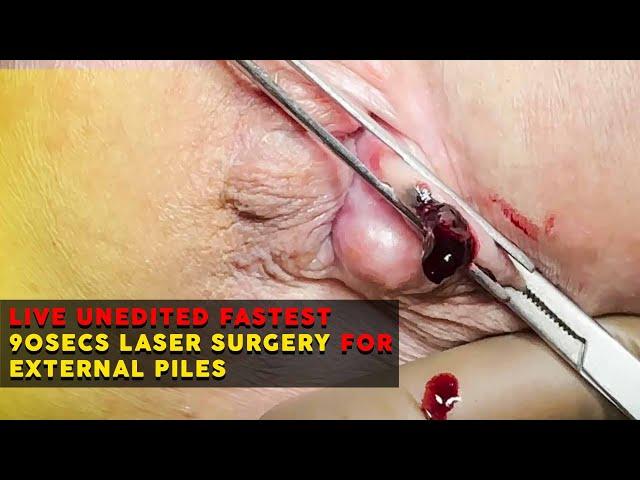 Live unedited fastest 90secs Laser Surgery for External Piles on American by Proctologist Dr Porwal