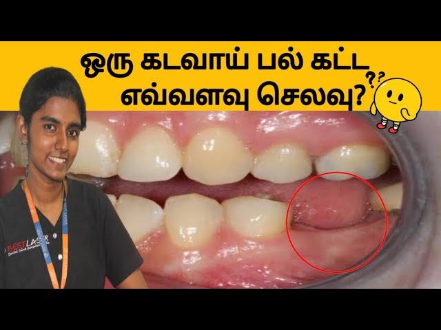 டென்டல் பிரிட்ஜ் என்றால் என்ன? நிறை, குறைகள்! Dental bridge, implant treatment best price in tamil