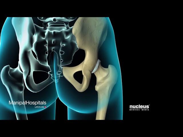 Total Hip Replacement Surgical Procedure | Top Orthopaedic Hospital In India | Manipal Hospitals