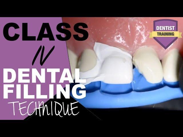 Class IV Composite Filling Tutorial | Front Tooth Filling