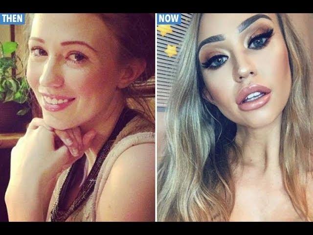 Big Brother 10 winner Sophie Reade looks totally different after having lip fillers