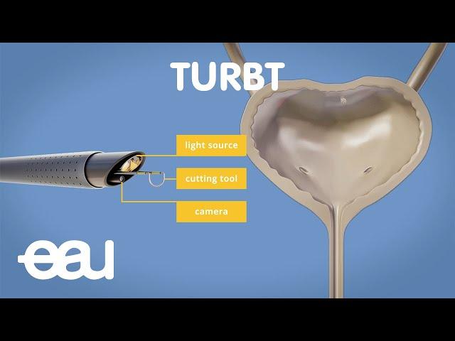 Bladder cancer treatment: TURBT