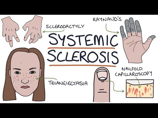 Systemic Sclerosis and Scleroderma: Visual Explanation for Students