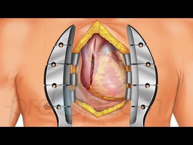 Coronary Artery Bypass Graft (CABG ) Off-Pump PreOp® Patient Education