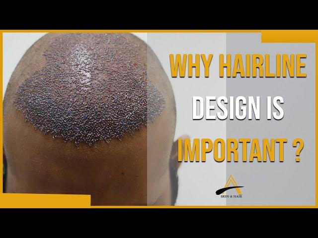 Why Hairline design is important for a Good Hair Transplant? | Dr Alok Sahoo