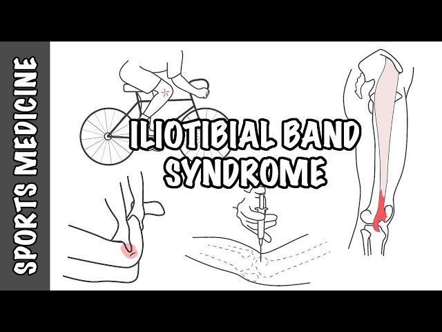 Iliotibial Band Syndrome (ITBS) - Overview