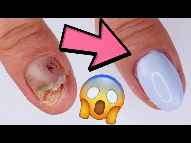 DAMAGED NAIL...