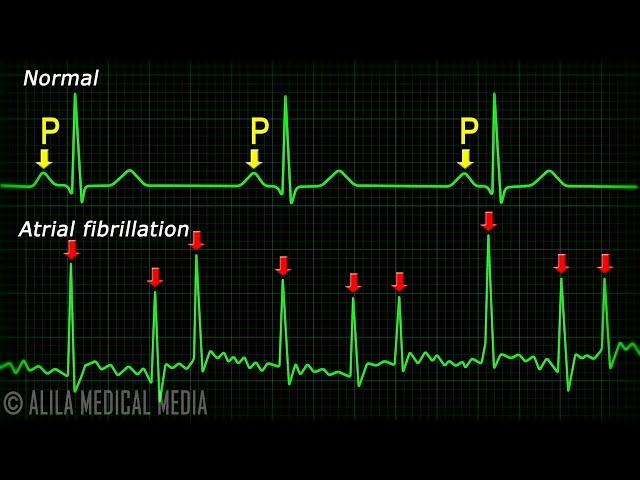 Atrial Fibrillation Anatomy, ECG and Stroke, Animation.