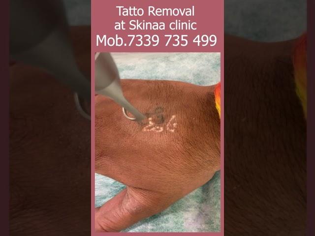 Tatto Removal at Skinaa Clinic