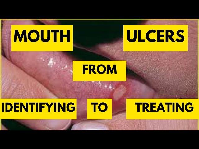 Mastering Recurrent Aphthous Stomatitis -Most Common Mouth Ulcers and Effective Treatment Strategies