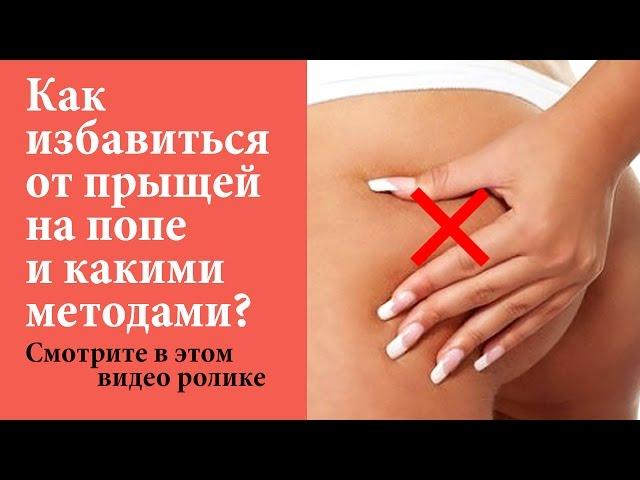 Прыщи на попе  5 ЭФФЕКТИВНЫХ методов от них избавиться! Смотрите в этом видео