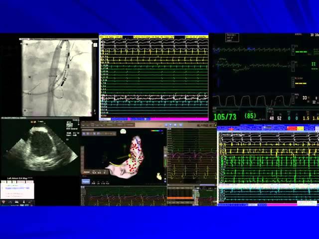 Ablation of Atrial Fibrillation with Complex Anatomy - kchrs2011