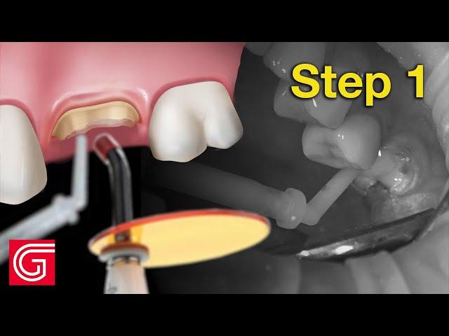 HOW TO Buildup Tooth #14 With Caries BEFORE Preparation