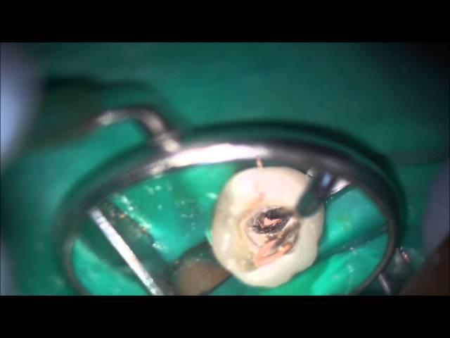 squirt or rapid flow obturation technique of root canals