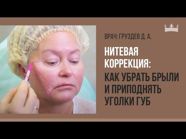 Нитевая коррекция: как убрать брыли и приподнять уголки губ