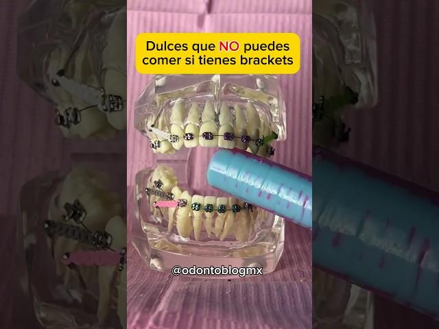 Dulces que NO puedes comer con brackets  #shorts #brackets #ortodoncia #odontoblog