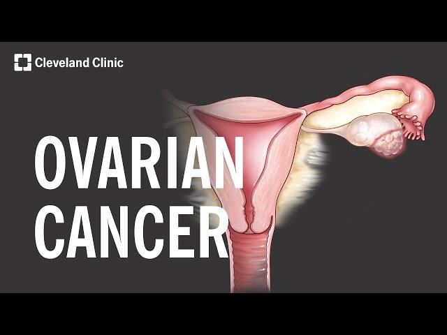 5 Warning Signs and Risk Factors of Ovarian Cancer