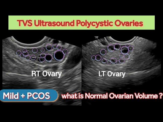 PCOS Polycystic Ovaries | Grading Mild |  Polycystic Ovarian Syndrome | PCOD | Ultrasound