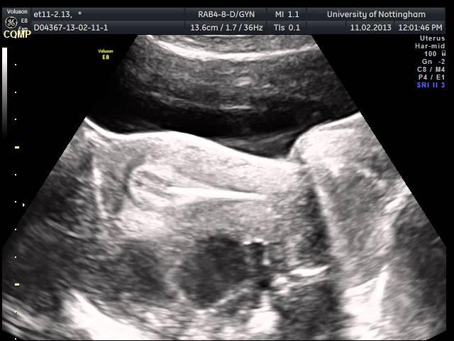 Ultrasound guided Embryo transfer