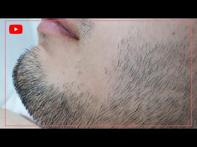 men beard hair removal waxing