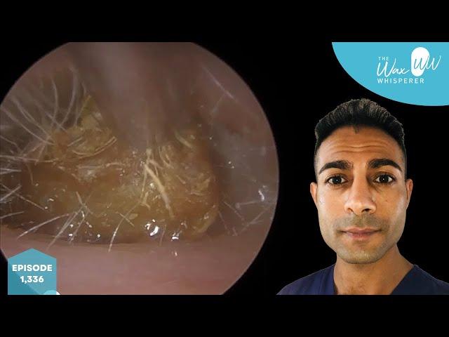 1,336 - Microsuction Ear Wax Removal with Superficial Otitis Externa