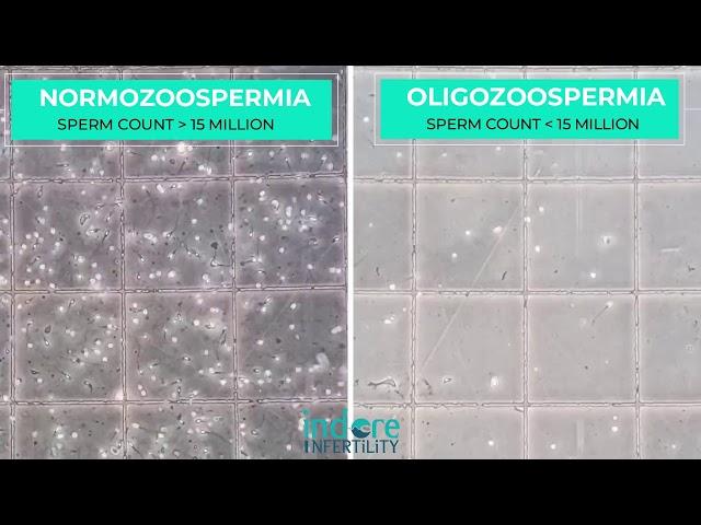 Oligozoospermia - Low Sperm Count. Comparison of Normal Semen Sample with sample with Low Count.