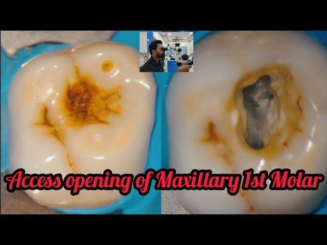 Access opening of Maxillary 1st Molar#step by step rootcanal treatment