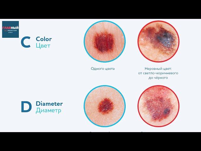 Меланома, базалиома и карцинома. Как выглядит рак кожи (фото). Симптомы и лечение рака кожи