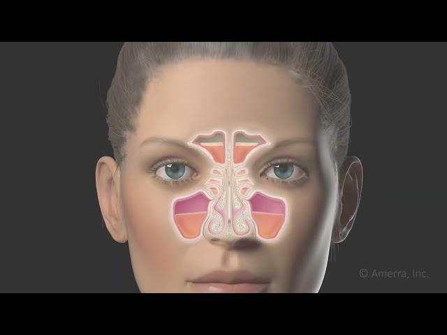 Functional endoscopic sinus surgery (FESS) - 3D animation