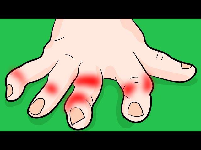 How to Stop Rheumatoid Arthritis in Your Fingers FAST!