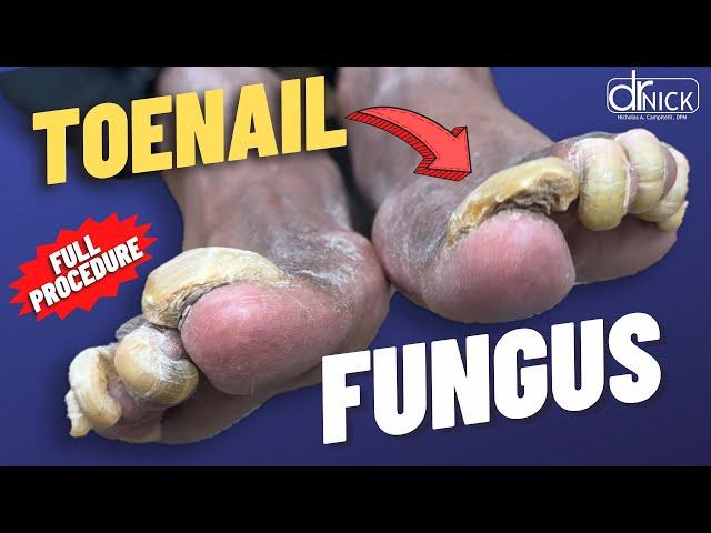 Cutting THICK fungus TOENAILS!