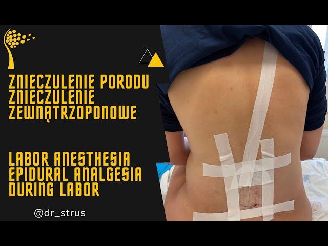 Znieczulenie porodu – znieczulenie zewnątrzoponowe // Labor anesthesia - Epidural analgesia