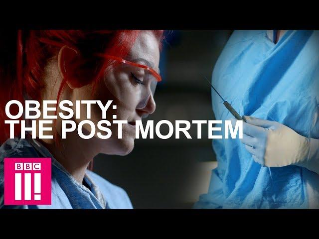 Autopsy On An Obese Woman: Obesity Post-Mortem