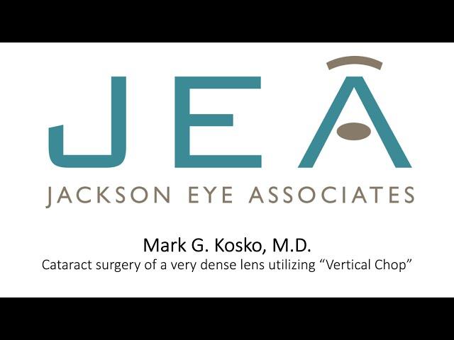 Kosko cataract surgery of a dense lens utilizing vertical chop