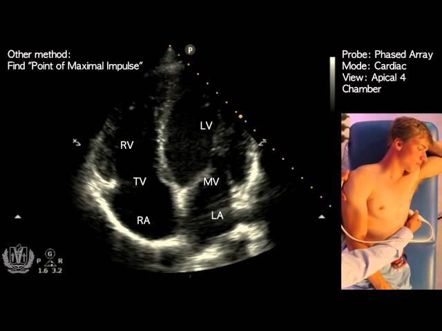 Apical 4 Chamber View on Transthoracic Echocardiography (Cardiac Ultrasound)