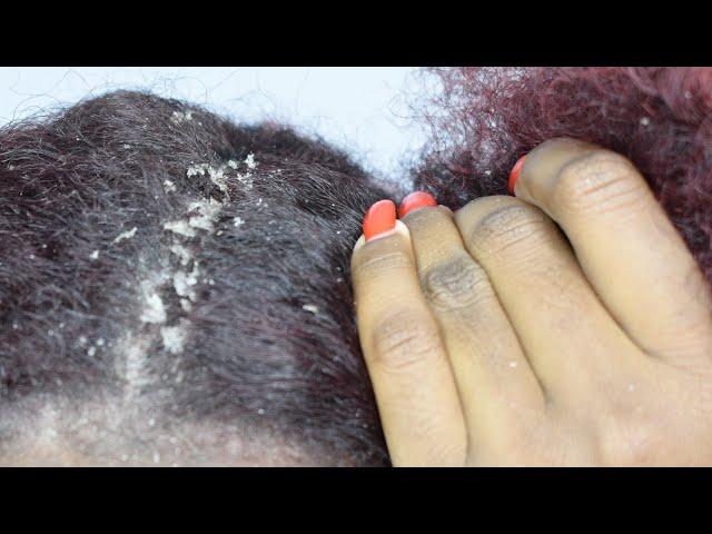 ITCHY DRY SCALP | SCRATCHING DANDRUFF