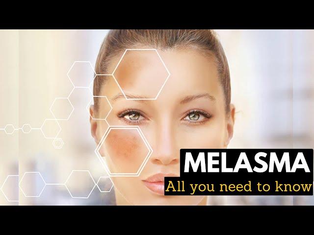 Melasma, Causes, Signs and Symptoms, Diagnosis and Treatment.