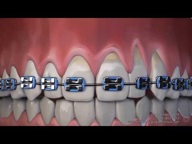 Gum Recession After Wearing Braces Can Now Be Treated Without Gum Grafting Surgery