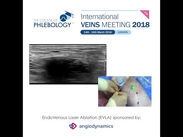 EndoVenous Laser Ablation - Live procedures at the 2nd International Veins Meeting