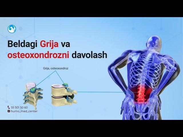 Beldagi Grija Va Osteoxondrozni Davolash