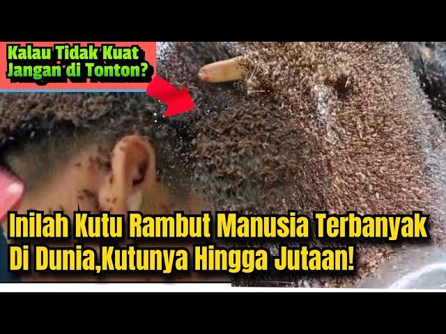 Kutu Rambut Manusia Terbanyak di Dunia || Kutunya Hingga Jutaan ⁉️