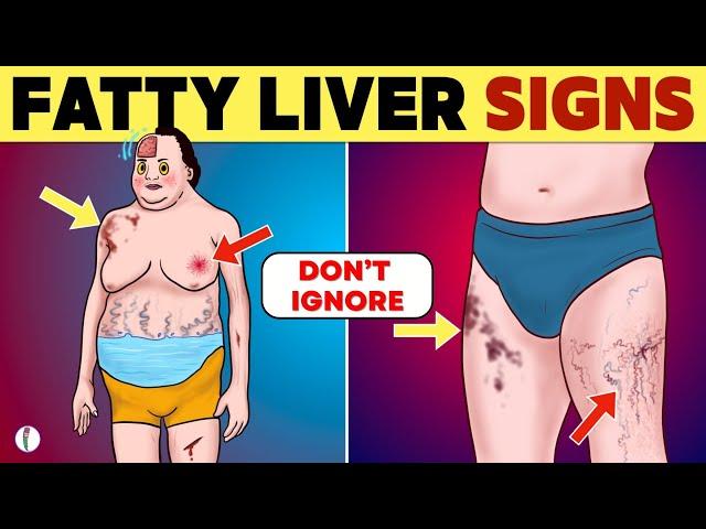 Fatty Liver Symptoms (2024 Update) | Fatty Liver Disease | Non Alcoholic Fatty Liver Disease