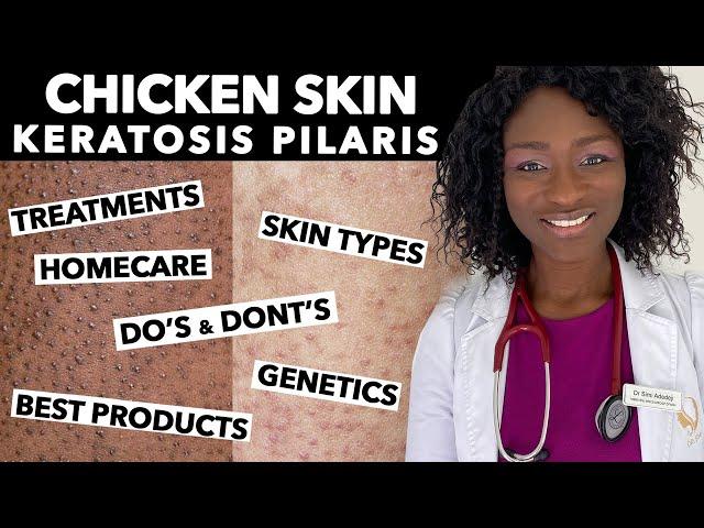 Keratosis Pilaris, Chicken Skin - Treating Dry Bumpy Skin | Special Tips for Black Skin | Ask Doctor