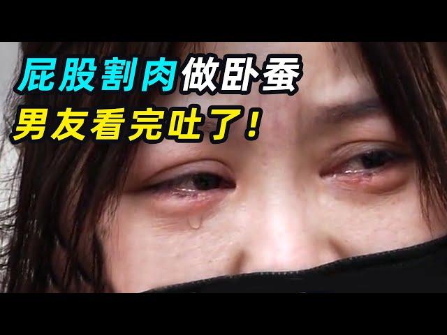 美女用臀部组织做卧蚕，手术失败大翻车，男友：分手吧！