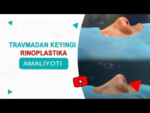 Travmadan keyingi rinoplastika amaliyoti