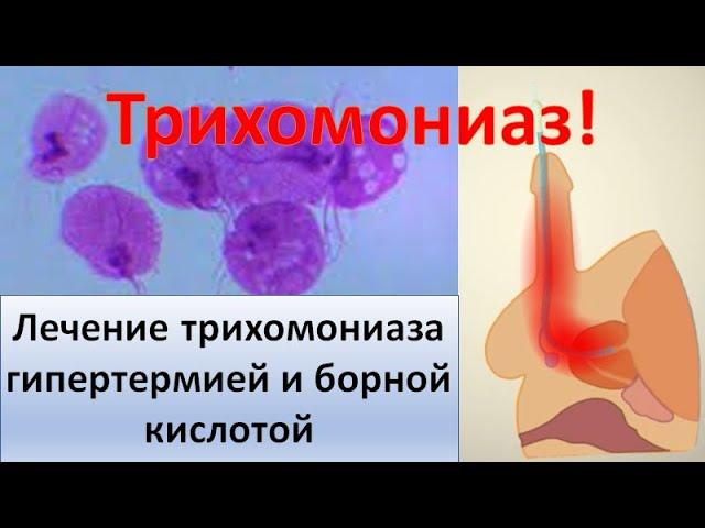 Лечение хронического трихомониаза гипертермией и борной кислотой