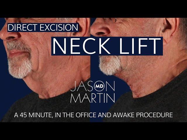 The magic of Direct Excision Neck Lifts