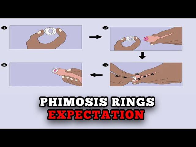 What you should expect from a PHIMOSIS RINGS TREATMENT