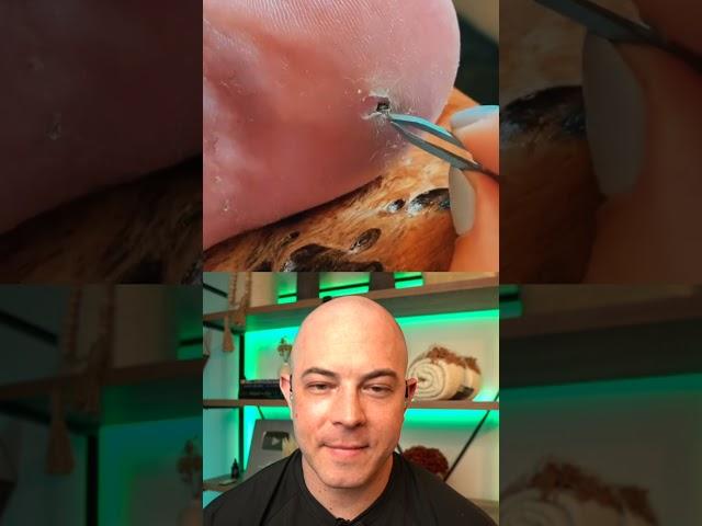 Doctor reacts to fat splinter removal! #dermreacts #doctorreacts #splinter #splinterremoval